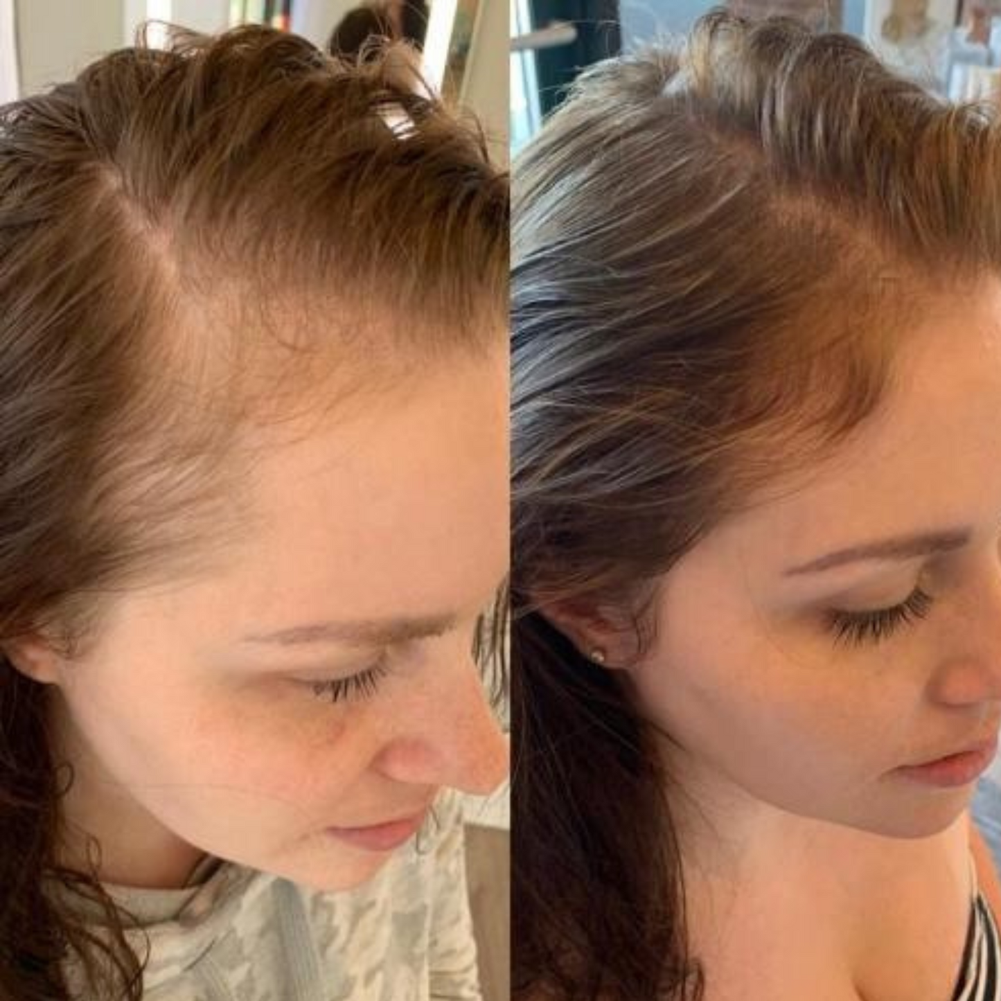 Thermapulse - Hair Growth System