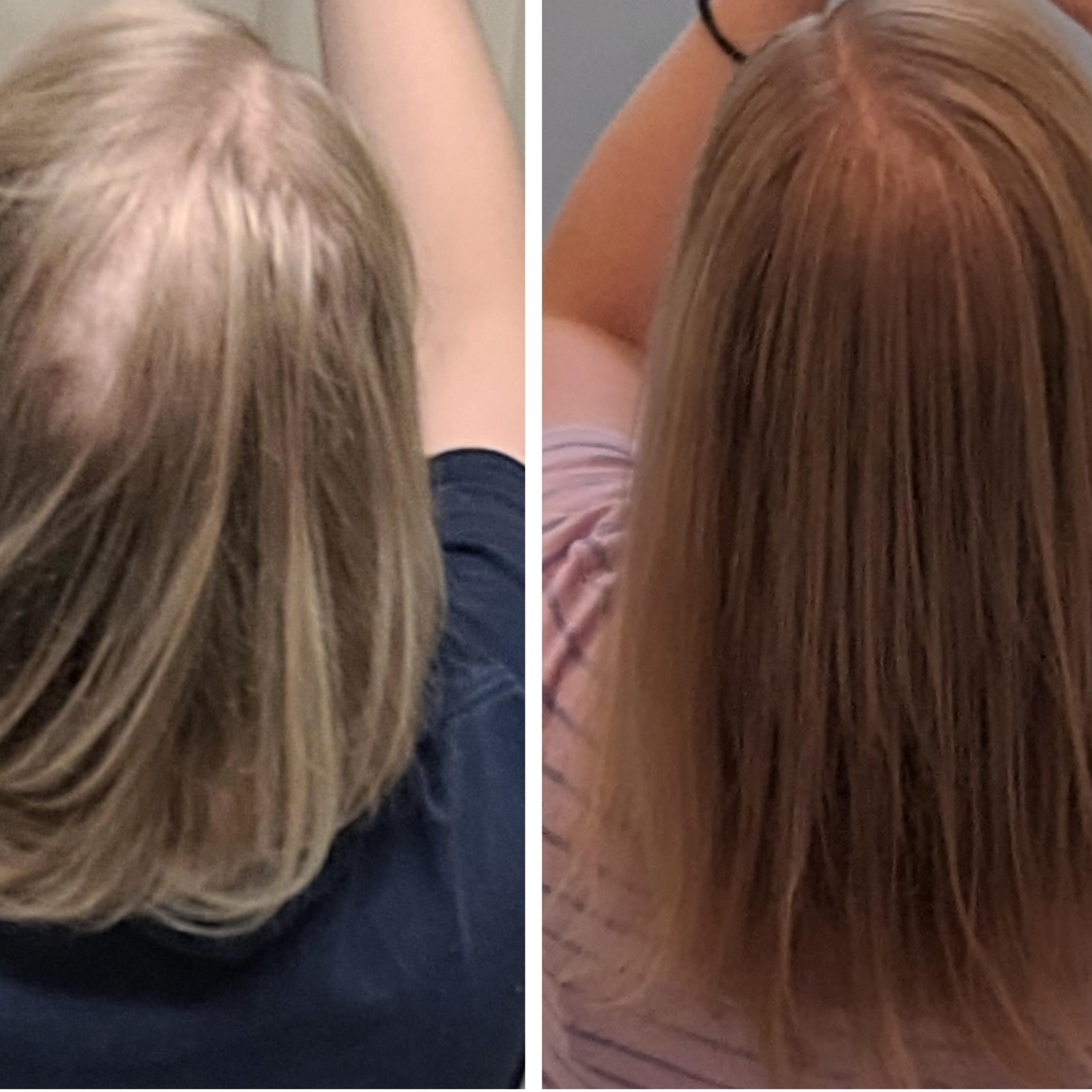 Thermapulse - Hair Growth System