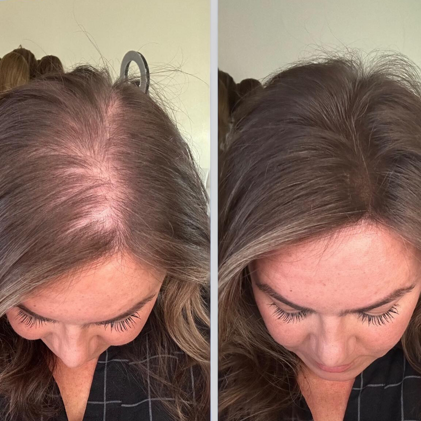 Thermapulse - Hair Growth System