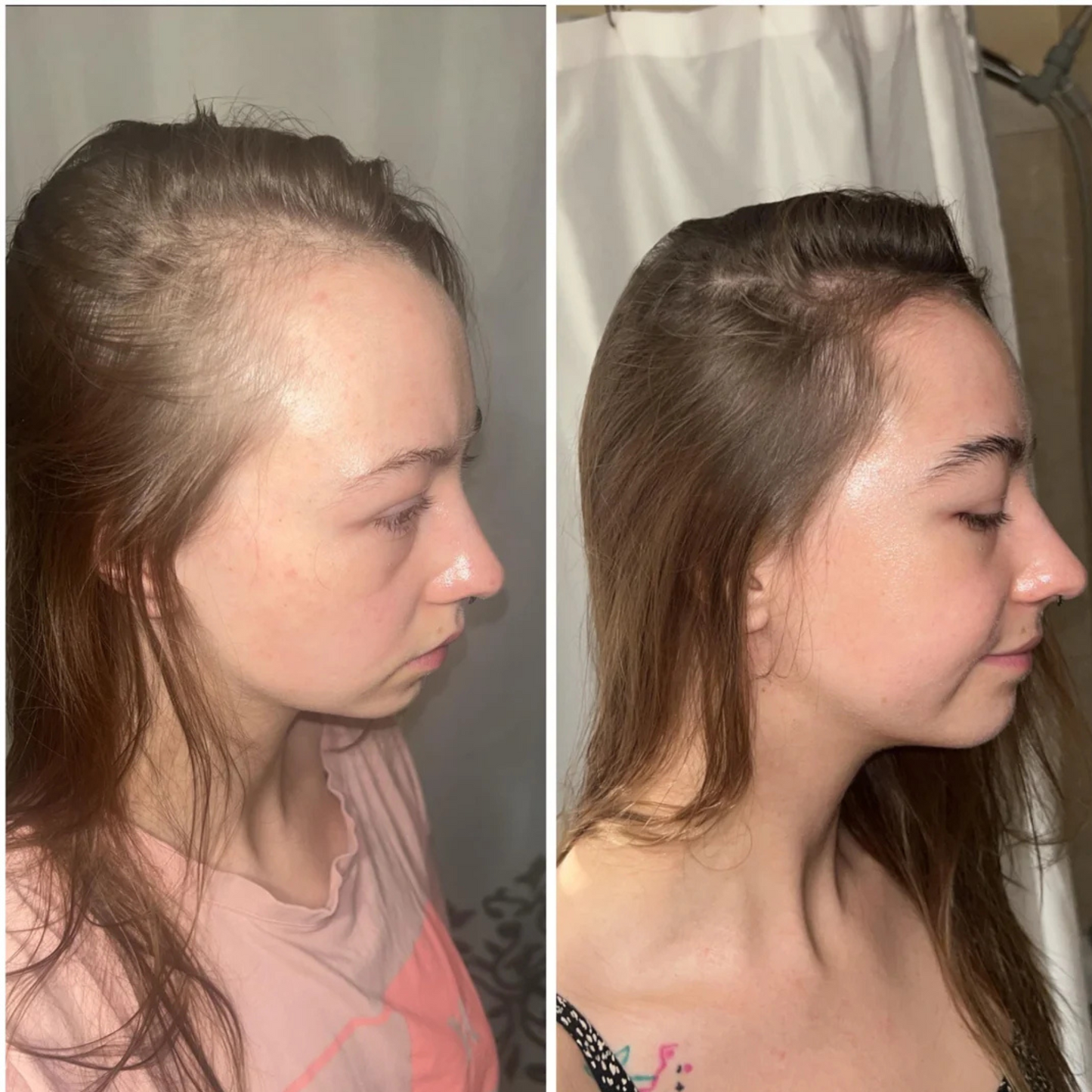 Thermapulse - Hair Growth System