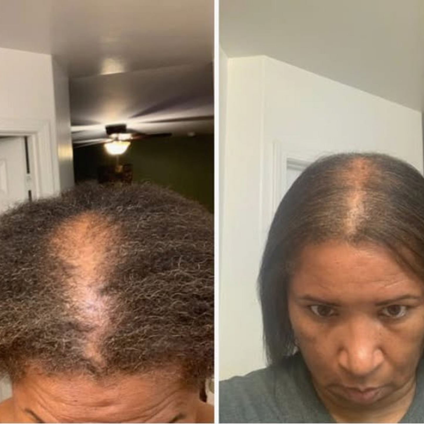 Thermapulse - Hair Growth System